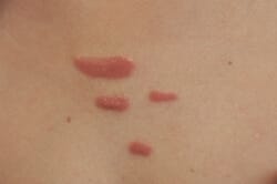 Keloid_scars_before_laser_I