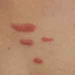 Permanent Keloid Removal