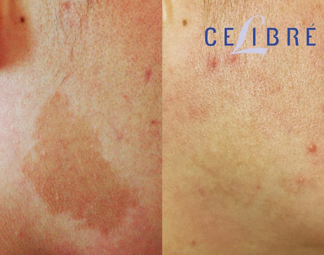 Laser Birthmark Removal