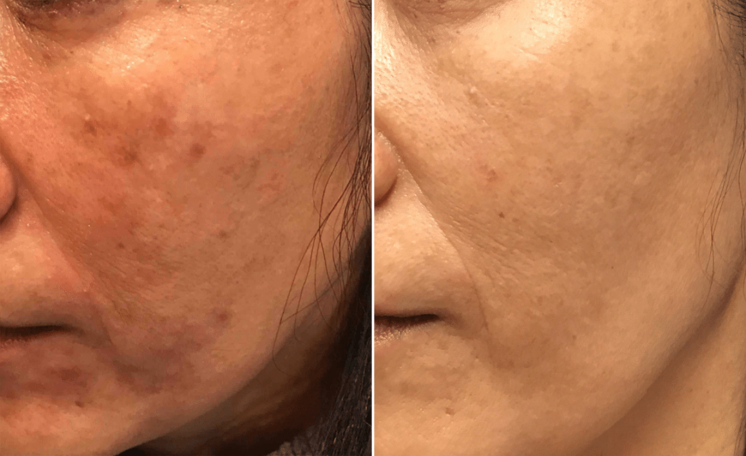 Laser Brown Spot Removal For Asian Skin 8145