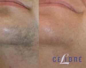 laser hair removal before and after