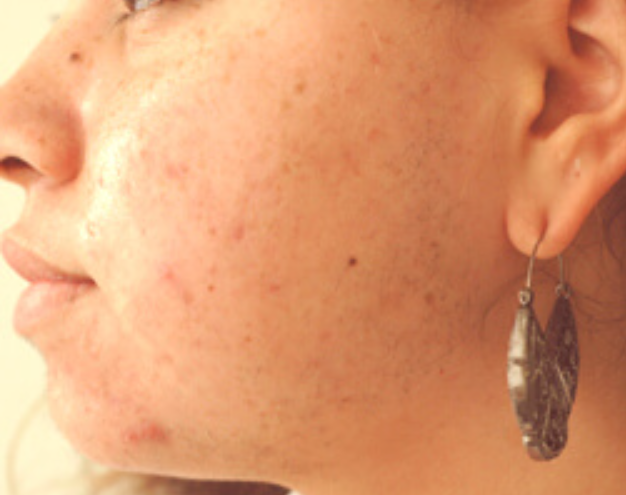 Laser Hair Removal Cost