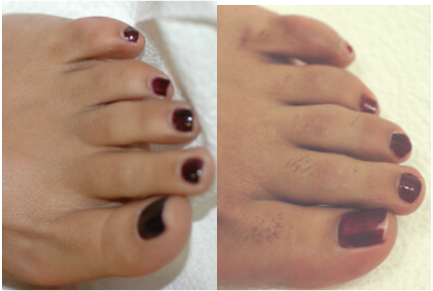 Laser Hair Removal Tips
