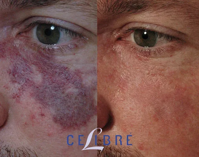 Port wine stain removal