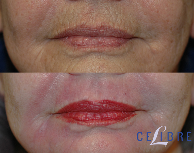 Laser Removal of Port Wine Stains