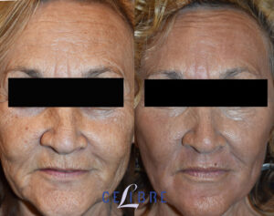 Ablative Laser Resurfacing