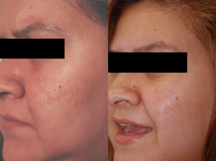 Laser Resurfacing Recovery Guidelines