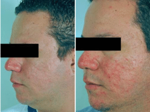 Laser Scar Removal Before and After