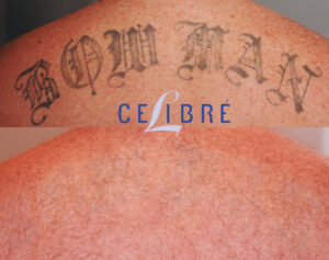 Laser Tattoo Removal