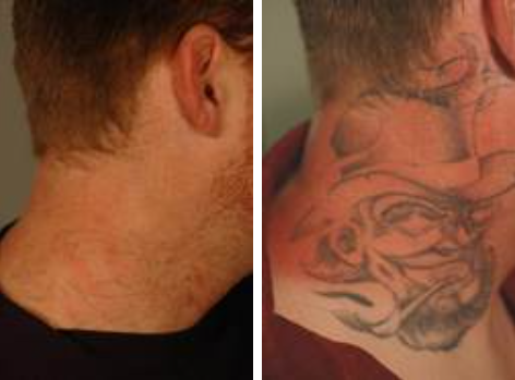 Laser Tattoo Removal Questions