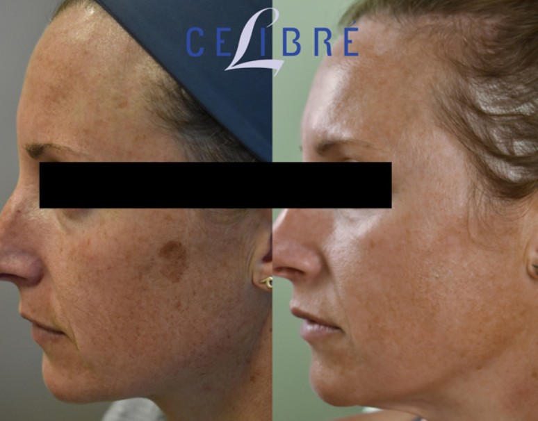 Laser Treatment for Age Spots