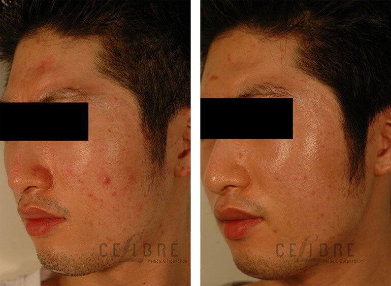 Laser Treatment for Pores