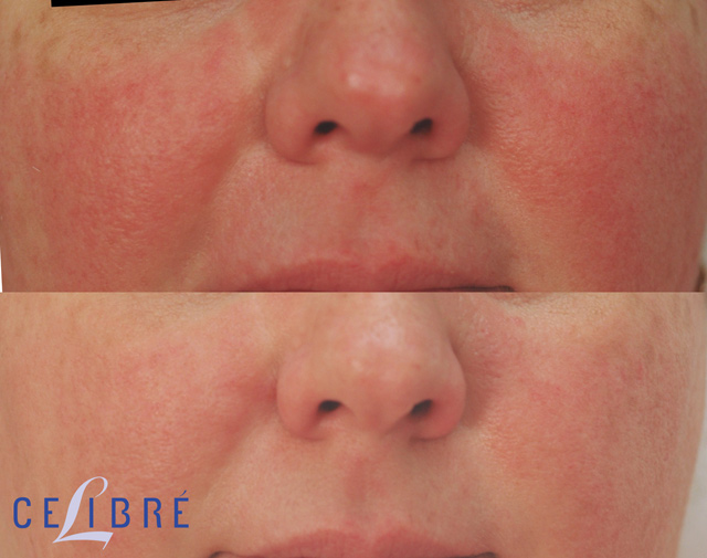 Laser Treatment for Rosacea