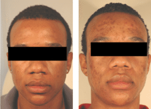 Laser Treatments for Different Skin Types