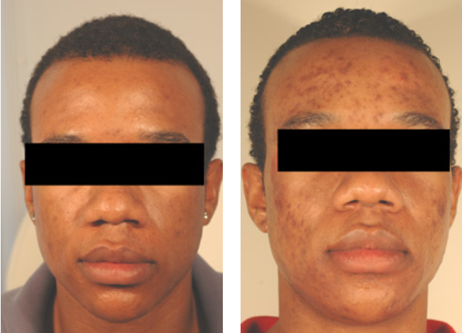 Laser Treatments for Different Skin Types