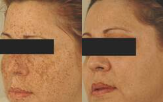 Laser Treatments
