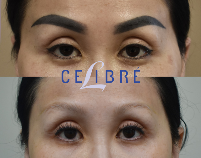 Witness the before-and-after transformation of laser eyebrow makeup removal for a clean, natural look.
