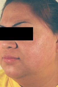 Los_Angeles_Laser_Resurfacing_Acne-Scars_after