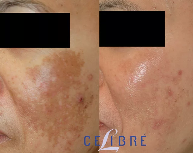 Melasma before and after