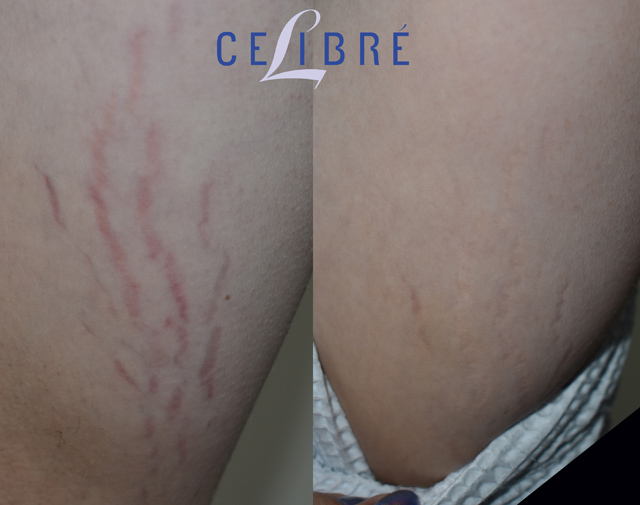 Newsletter August Stretch Mark Removal