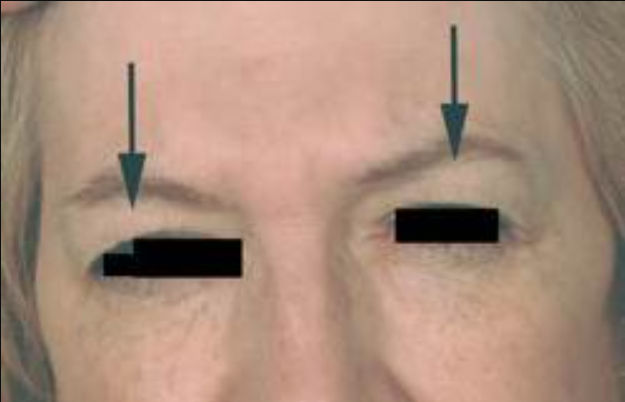 Newsletter January Botox Brow Lift