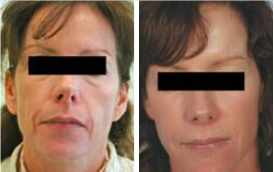 Newsletter January Laser Hair Removal