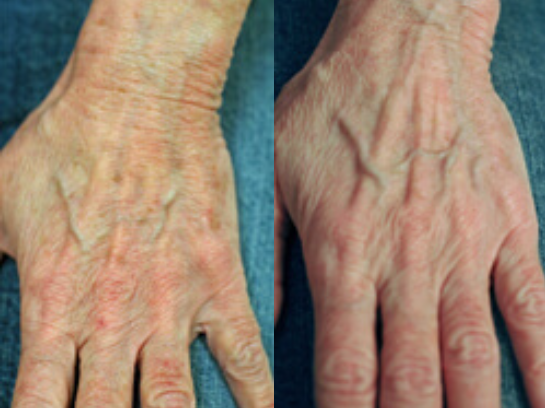 Newsletter July Hand Rejuvenation