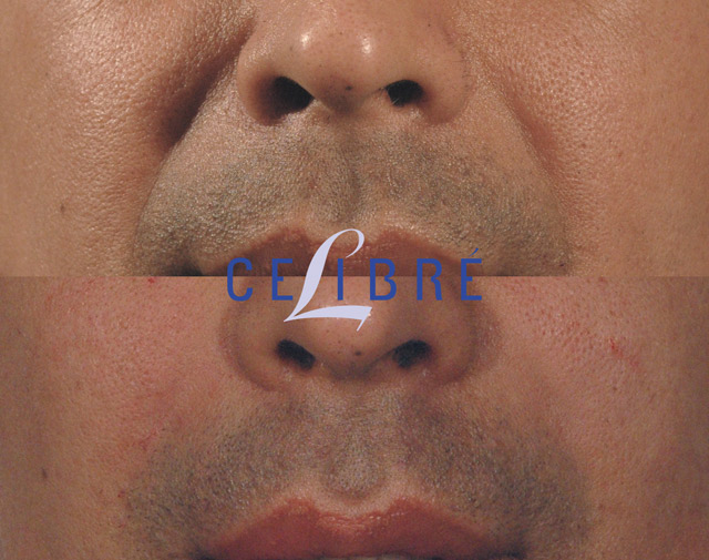 Newsletter June Restylane