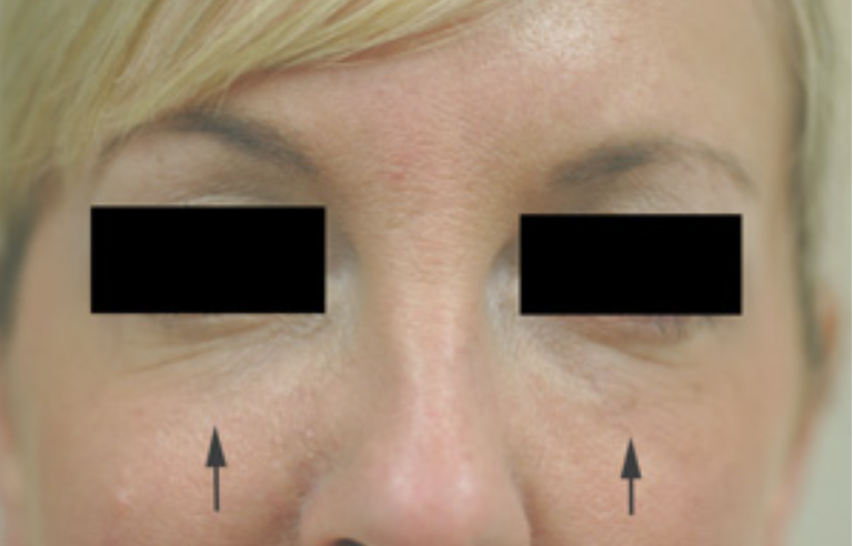 Newsletter October Restylane & Latisse