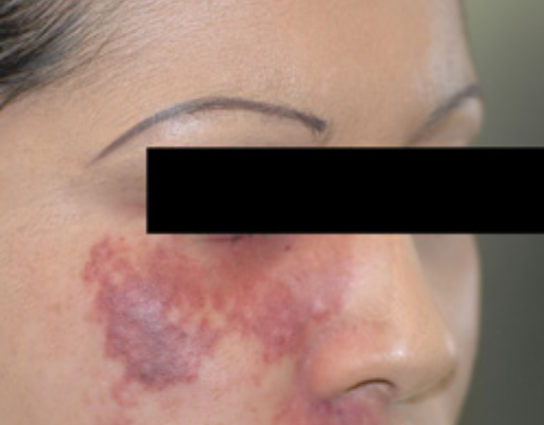 Newsletter September Birthmark Removal