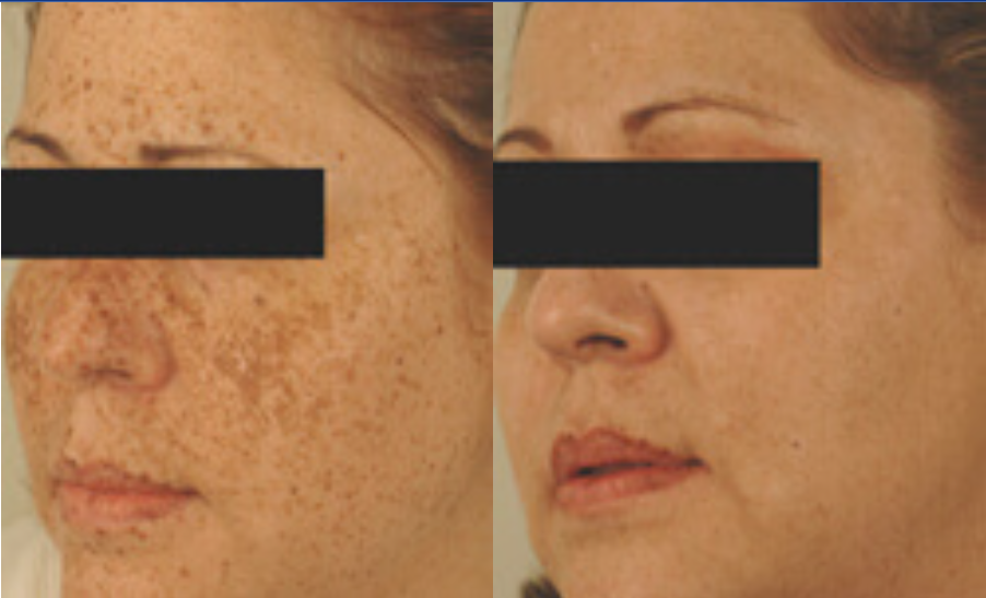 Newsletter September Brown Discoloration