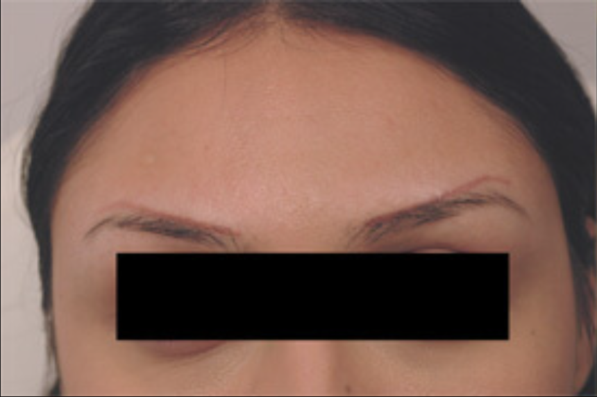 Permanent Makeup Laser Treatment