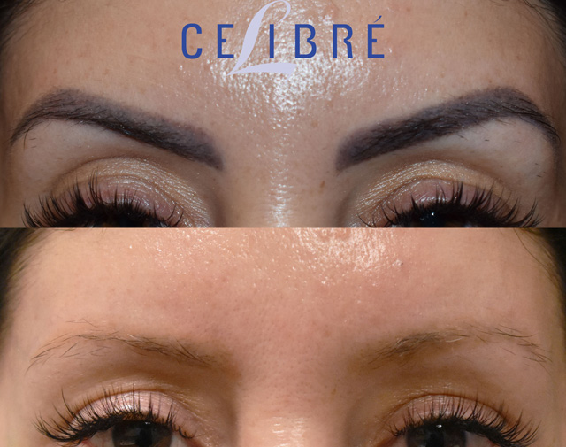 Cosmetic Eyebrow Tattoo Removal Sydney  Clean Canvas Laser Clinic