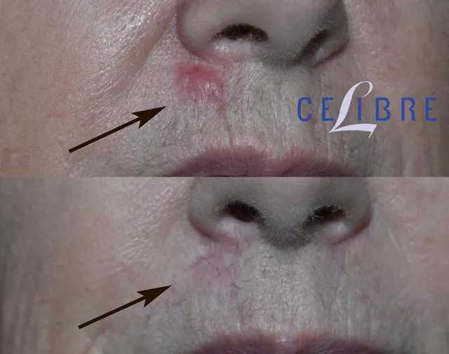 Permanent keloid removal