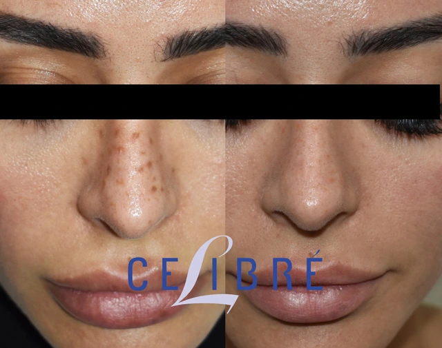 Permanent makeup removal for freckles: a side-by-side look at the before and after laser treatment process.