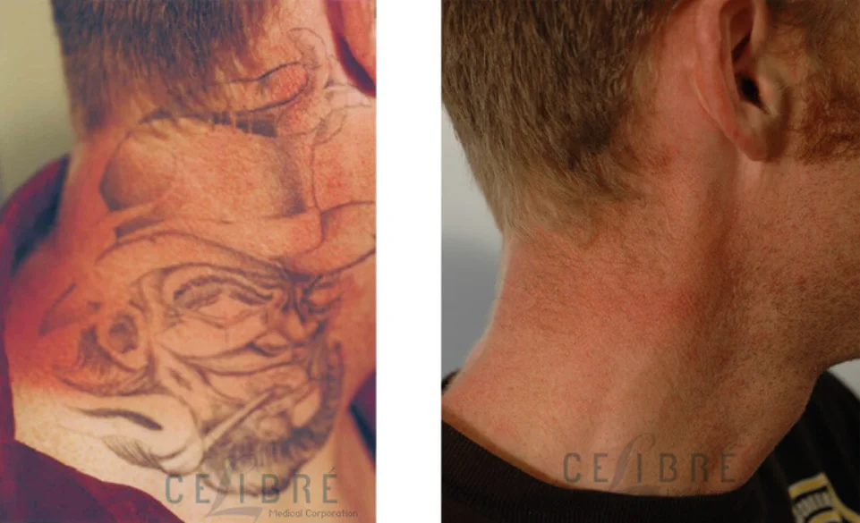 Picosure Tattoo Removal