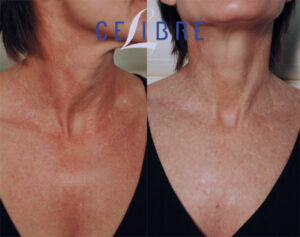 Poikiloderma Before And After