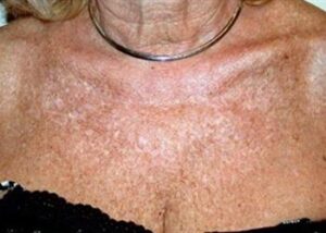 Poikiloderma-Discoloration-Neck-Chest