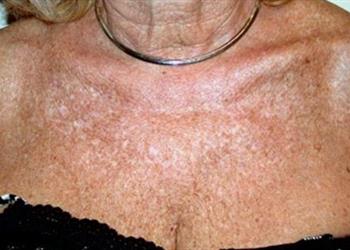 Poikiloderma-Discoloration-Neck-Chest