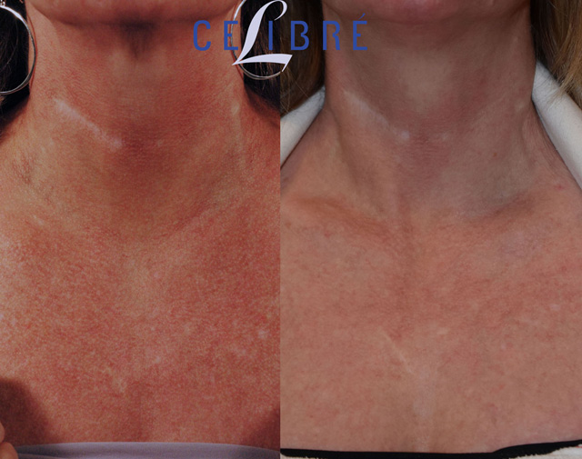 Poikiloderma Treatment