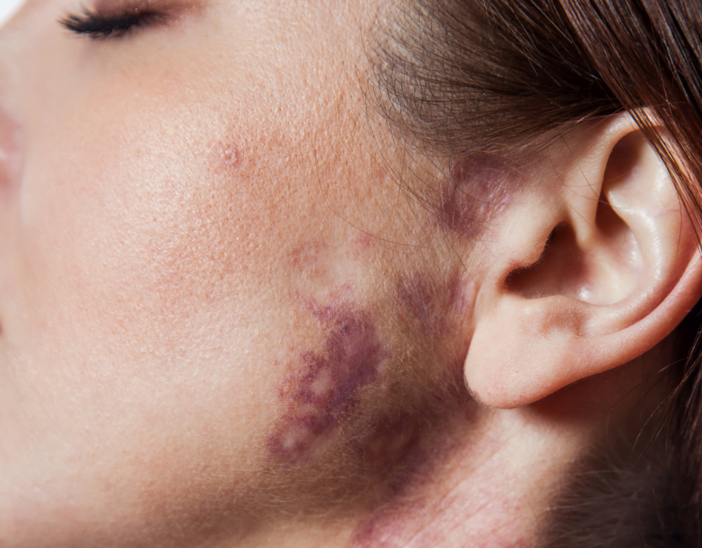 The Ultimate Guide to Removing Port Wine Stains with Lasers