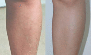 Discoloration Laser Treatment