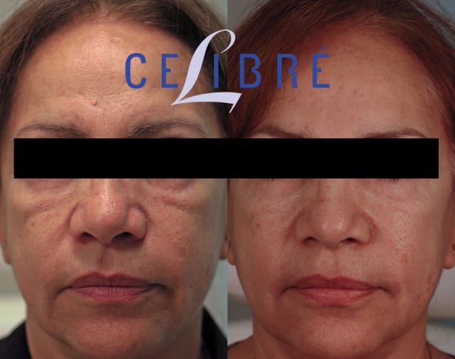 restylane filler cost