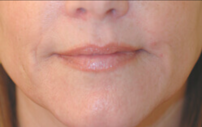 Restylane Lyft