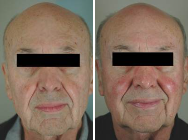 Rosacea Treatment