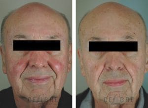 Rosacea Laser Removal