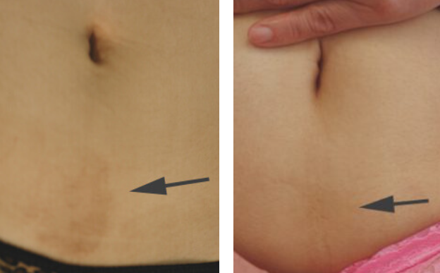 Scar Treatments
