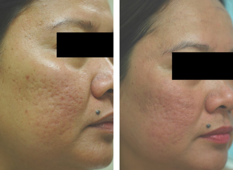 Erbium Laser Resurfacing