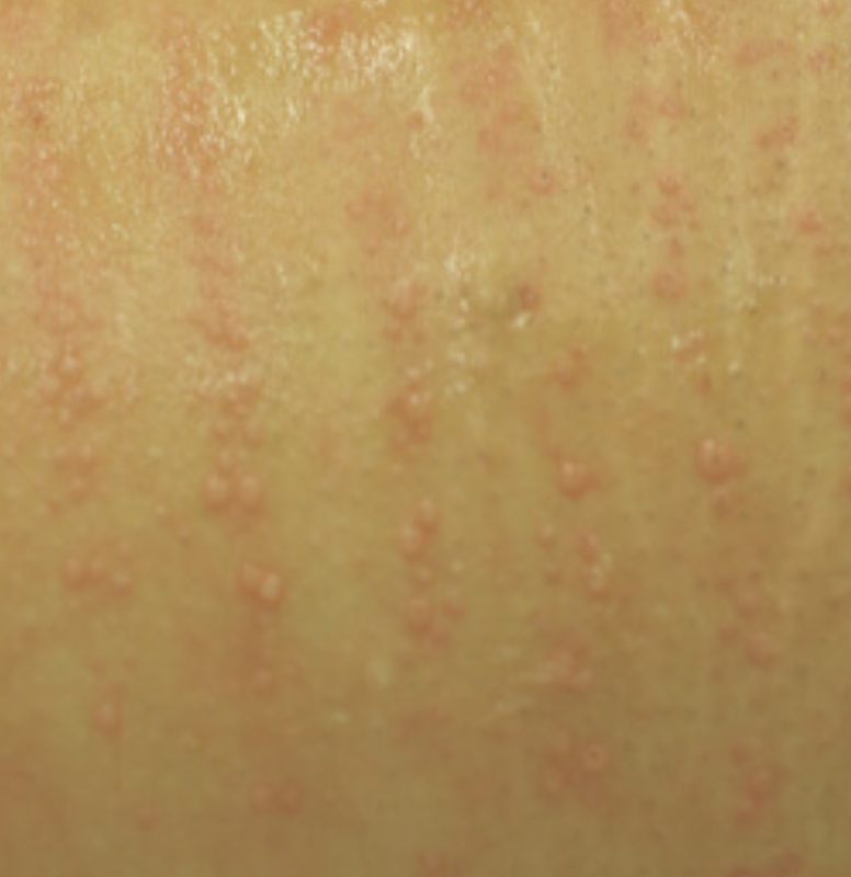 Follicular Edema