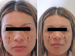 Do cosmetic injections hurt